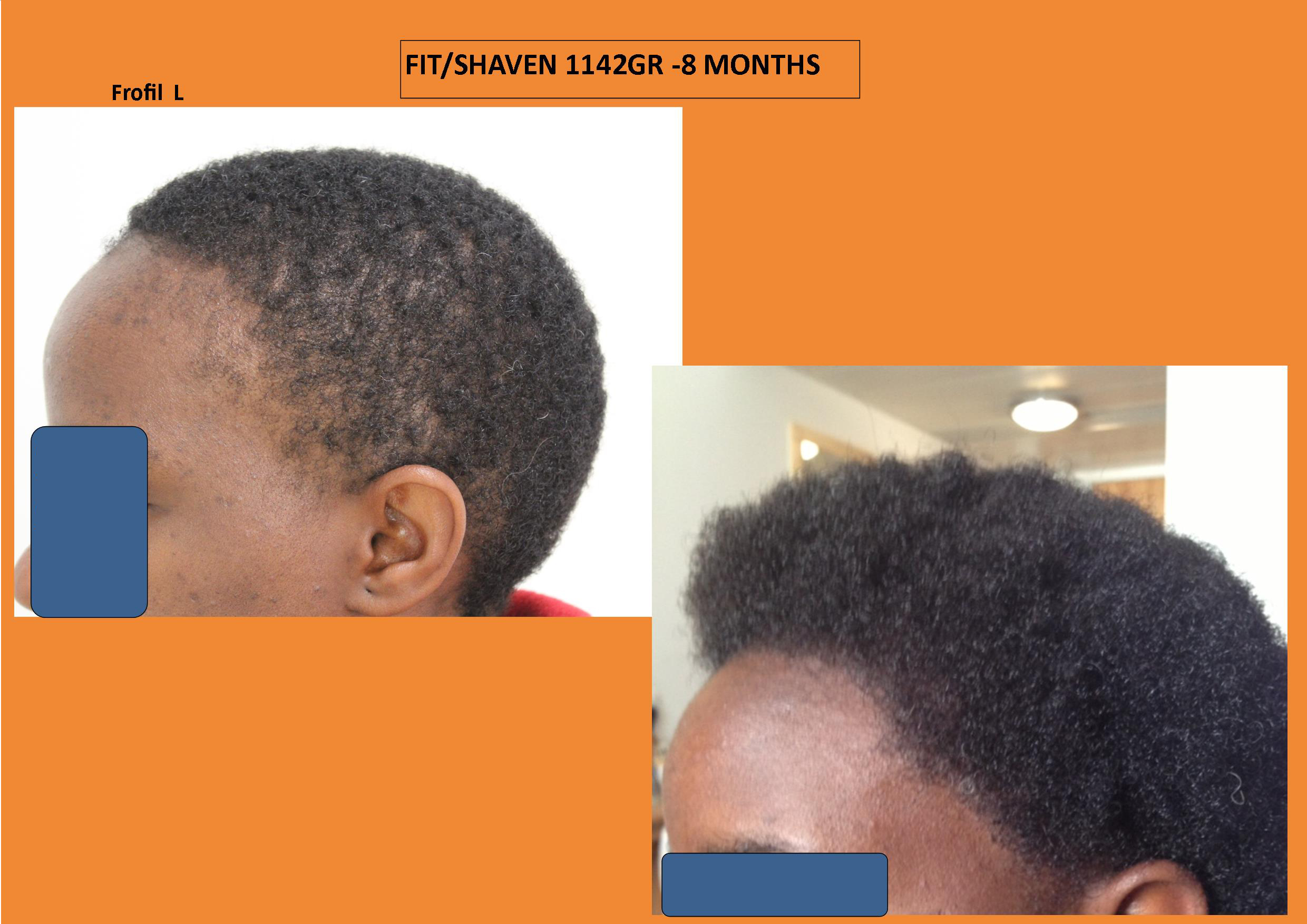 Afrikaner - Africans Haartransplantation Vergleich links
