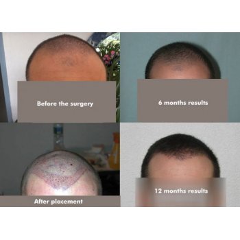 Compare before, directly after the operation, result 6 months and result 12 months
