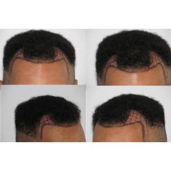 Consultation for the hair transplant 
