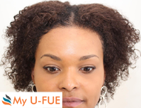 My U-FUE bei Frauen